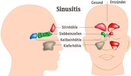 Sinusitis